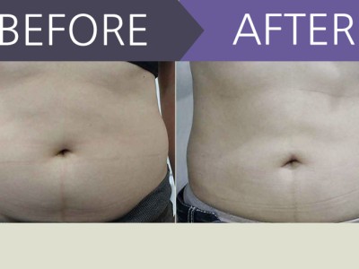 복부지방흡입 한달