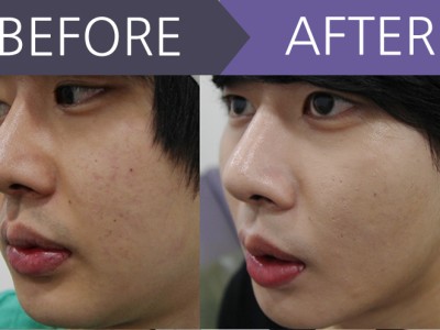 이중턱 지방흡입