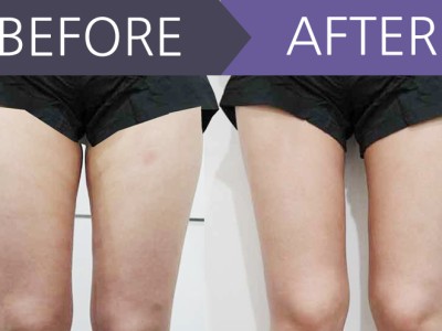 허벅지 지방흡입