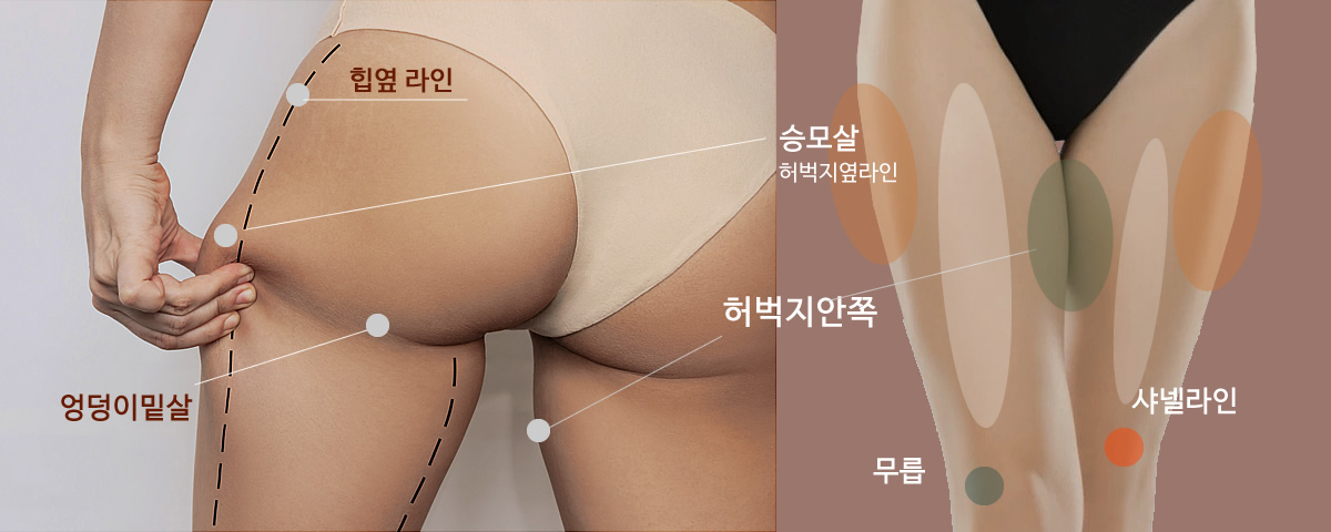 시술부위